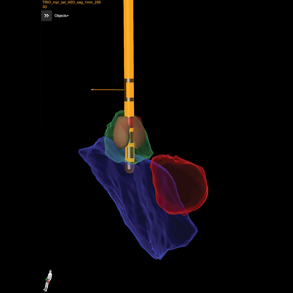 Animation des XT Screens beim Verfahren der Tiefen Hirnstimulation (THS)