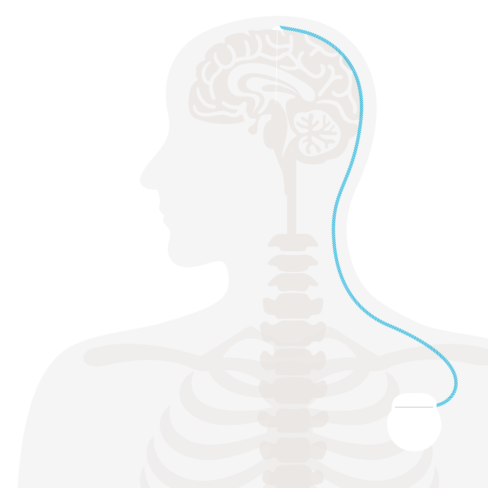 Illustration zum Thema Tiefe Hirnstimulation (THS): ein Torso und die Verbindung von Gehirn und Hirnschrittmacher